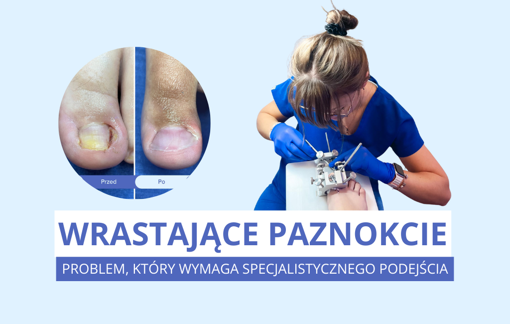 Otopodolog | Problemy z wrastającymi paznokciami